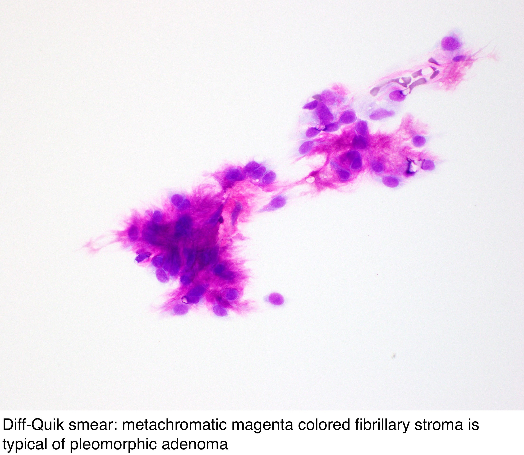 pleomorphic adenoma pathology outlines cytology