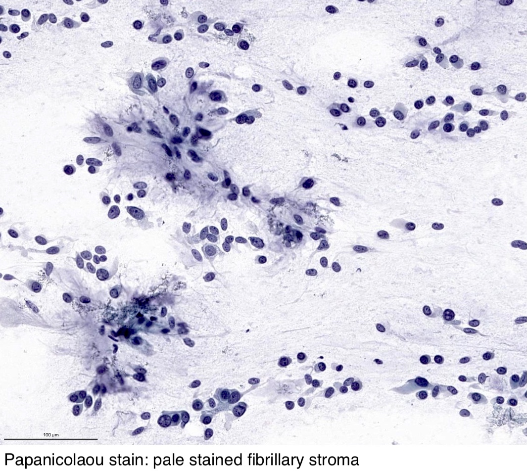 pleomorphic adenoma skin pathology outlines)