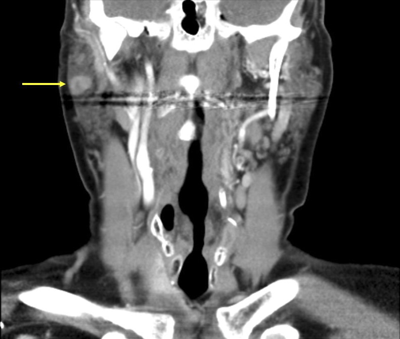 CT coronal view