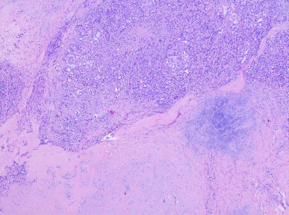 Carcinoma ex pleomorphic adenoma
