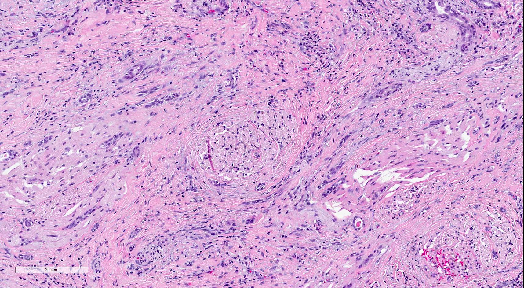 Infiltrative tubules and poorly formed glands