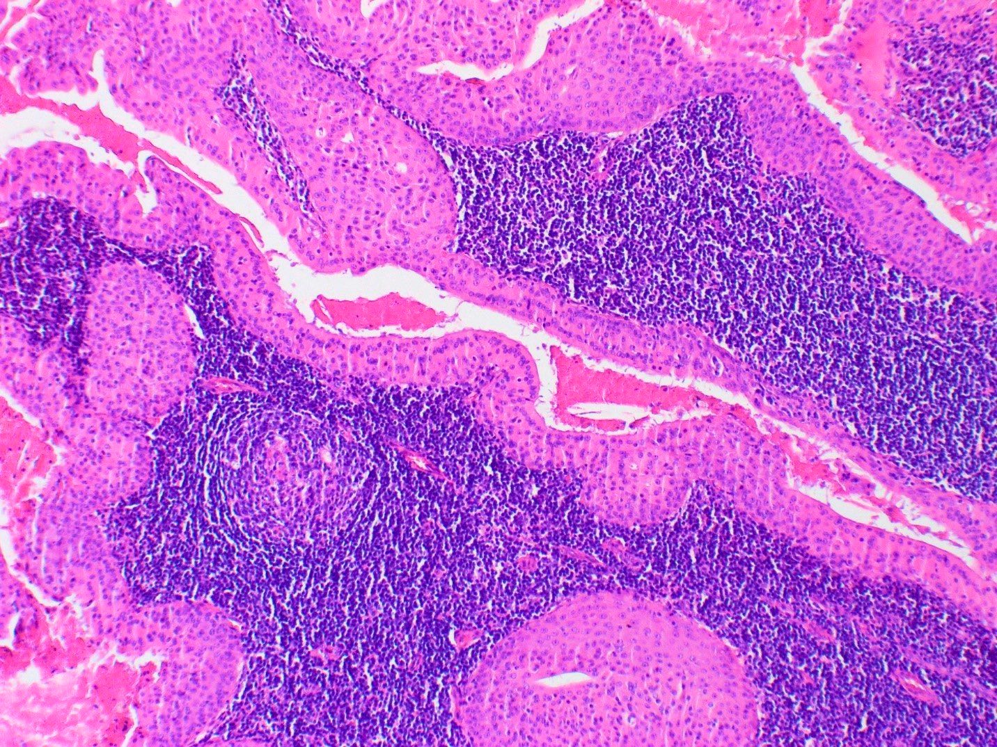 Bilayered oncocytic epithelium with lymphoid background