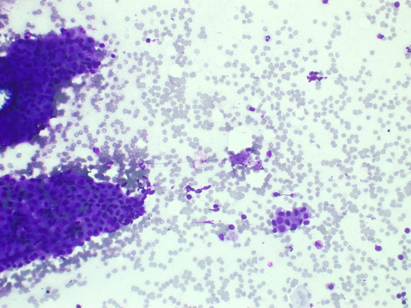 Oncocytic cells with dense cytoplasm