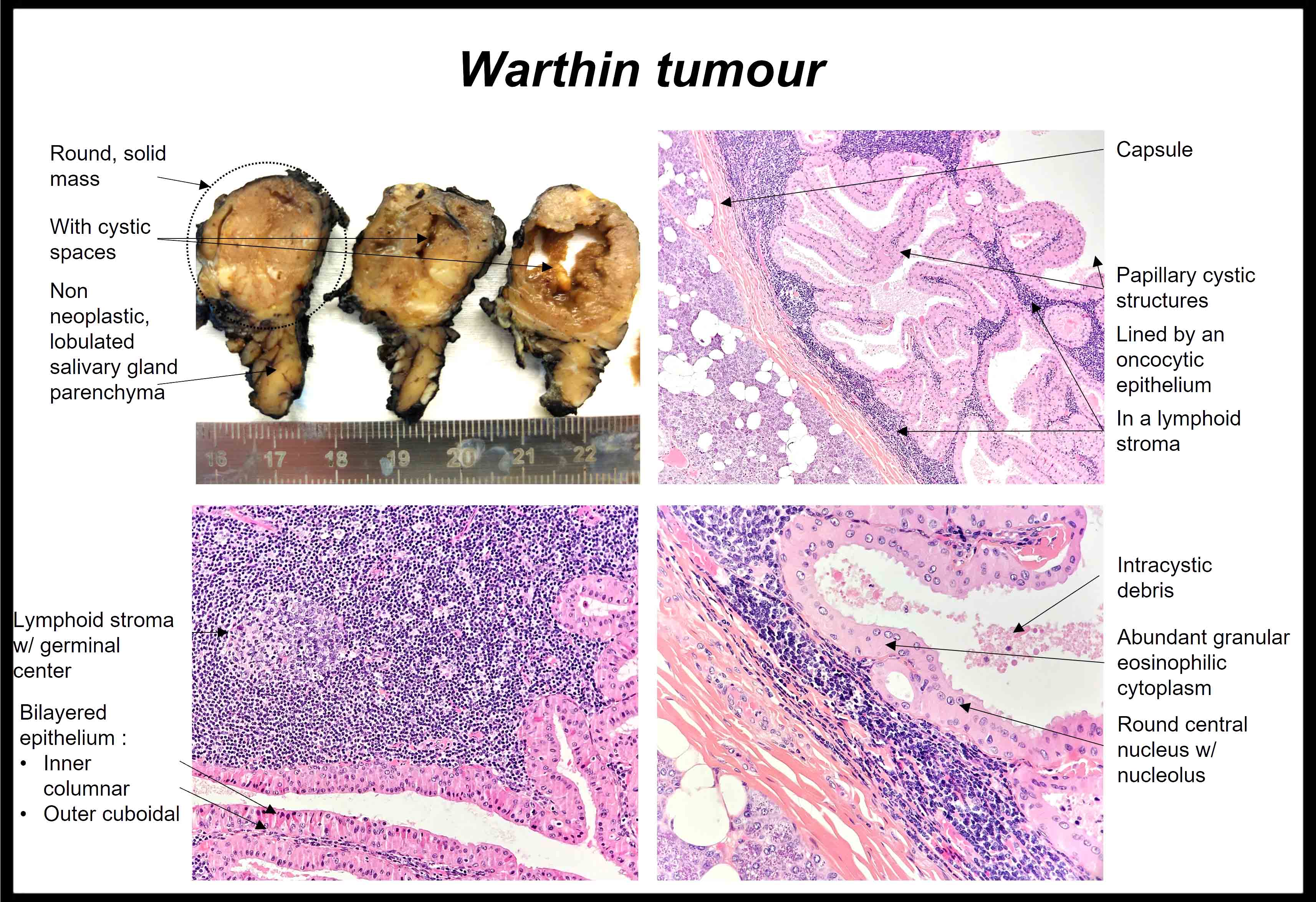 Warthin tumor