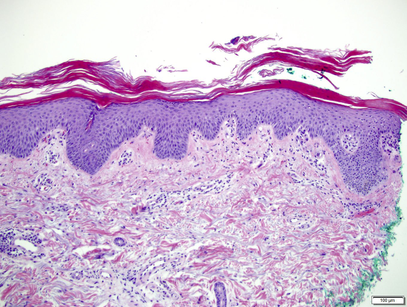 Pathology Outlines - Pityriasis rubra pilaris