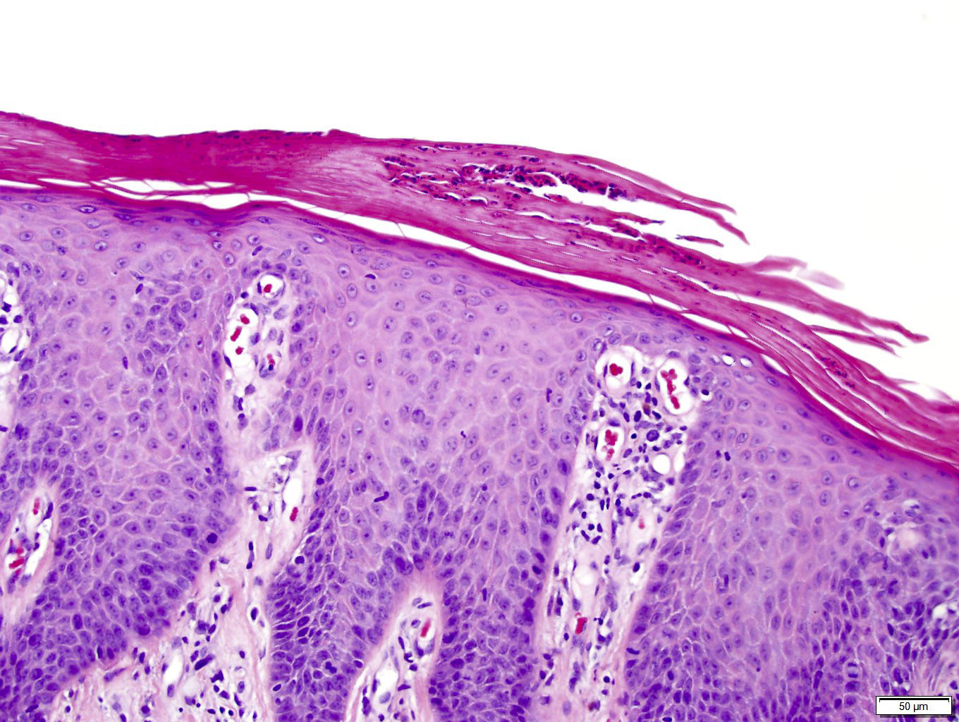 Pikkelysömör pathomorphology