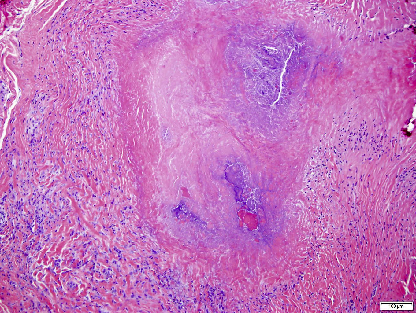 Rheumatoid Arthritis Histology