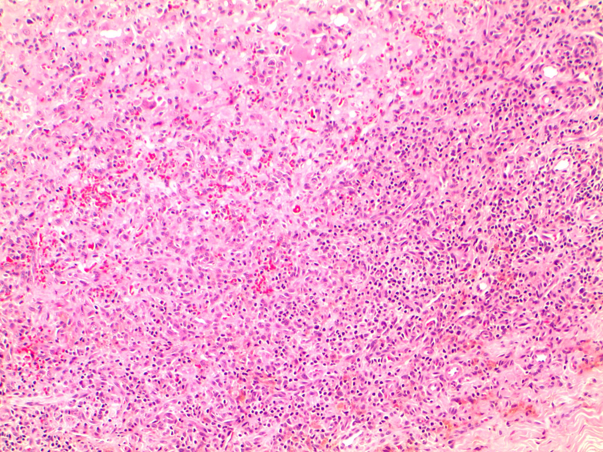 Mixed inflammation with hemosiderin deposition