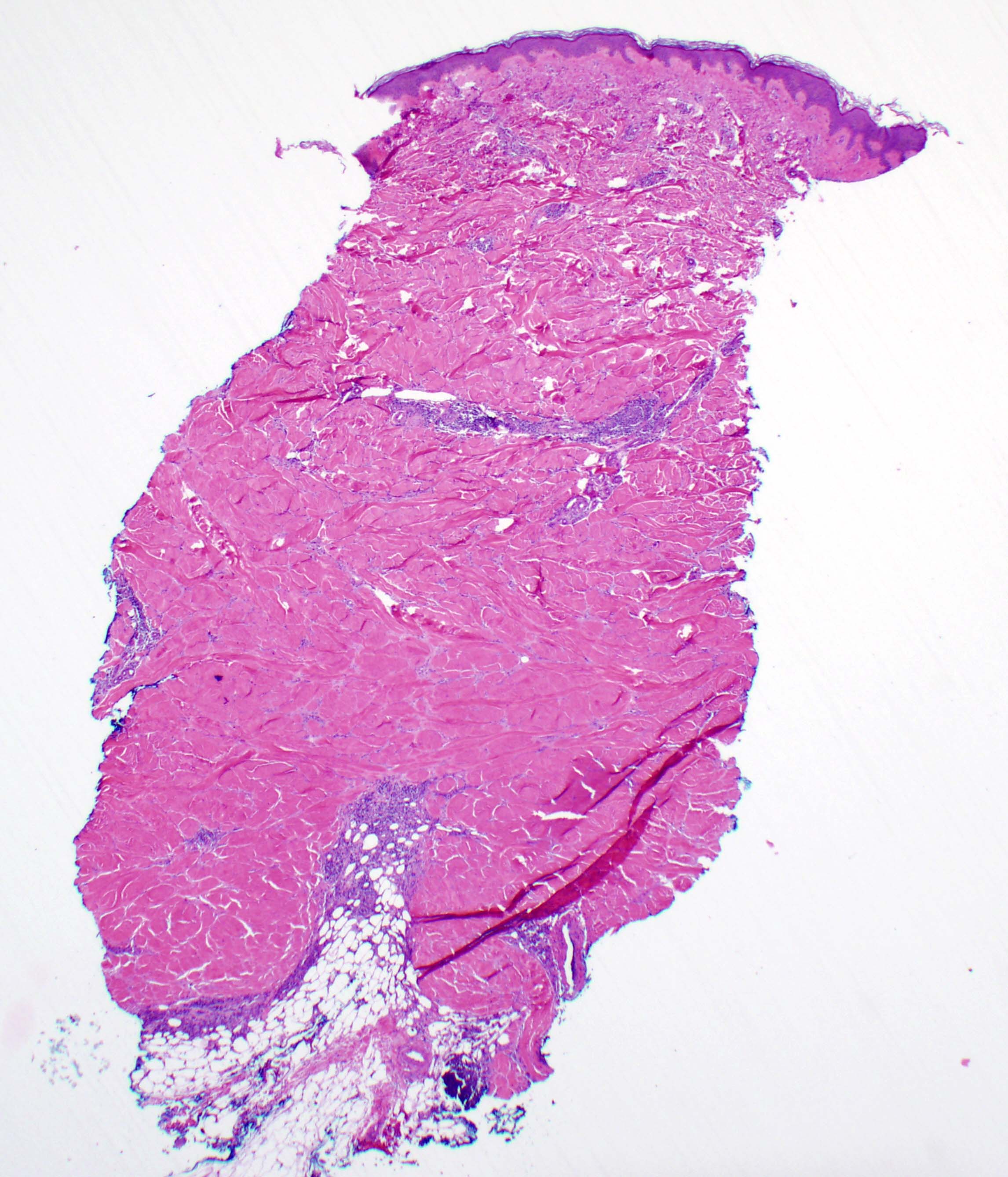 Early scleroderma lesion