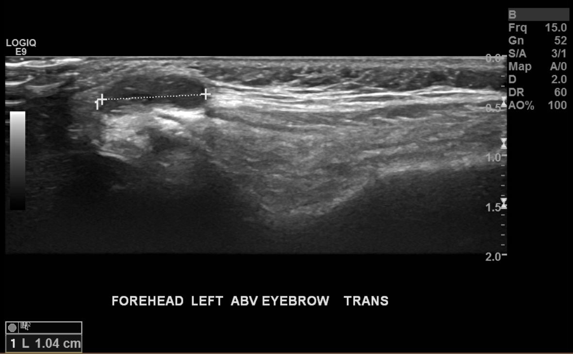 Ultrasonography of a palpable lump over the left eyebrow
