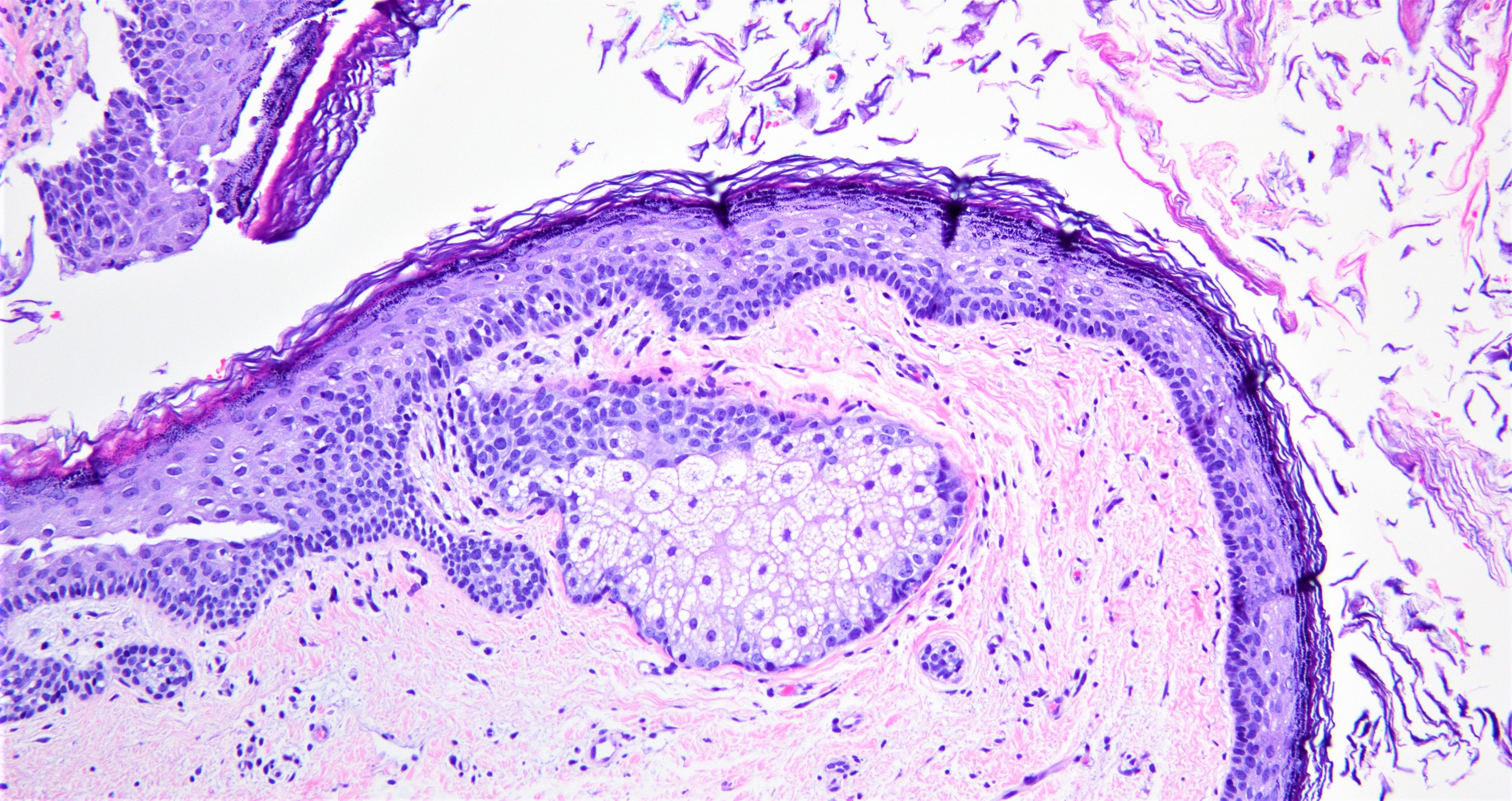 Lining epithelium in dermoid cyst
