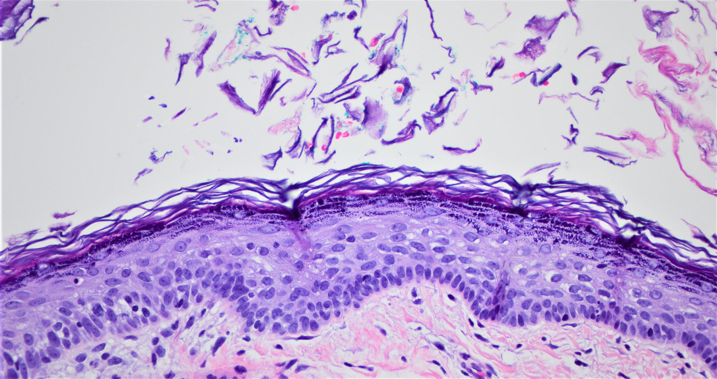 Lining epithelium in dermoid cyst