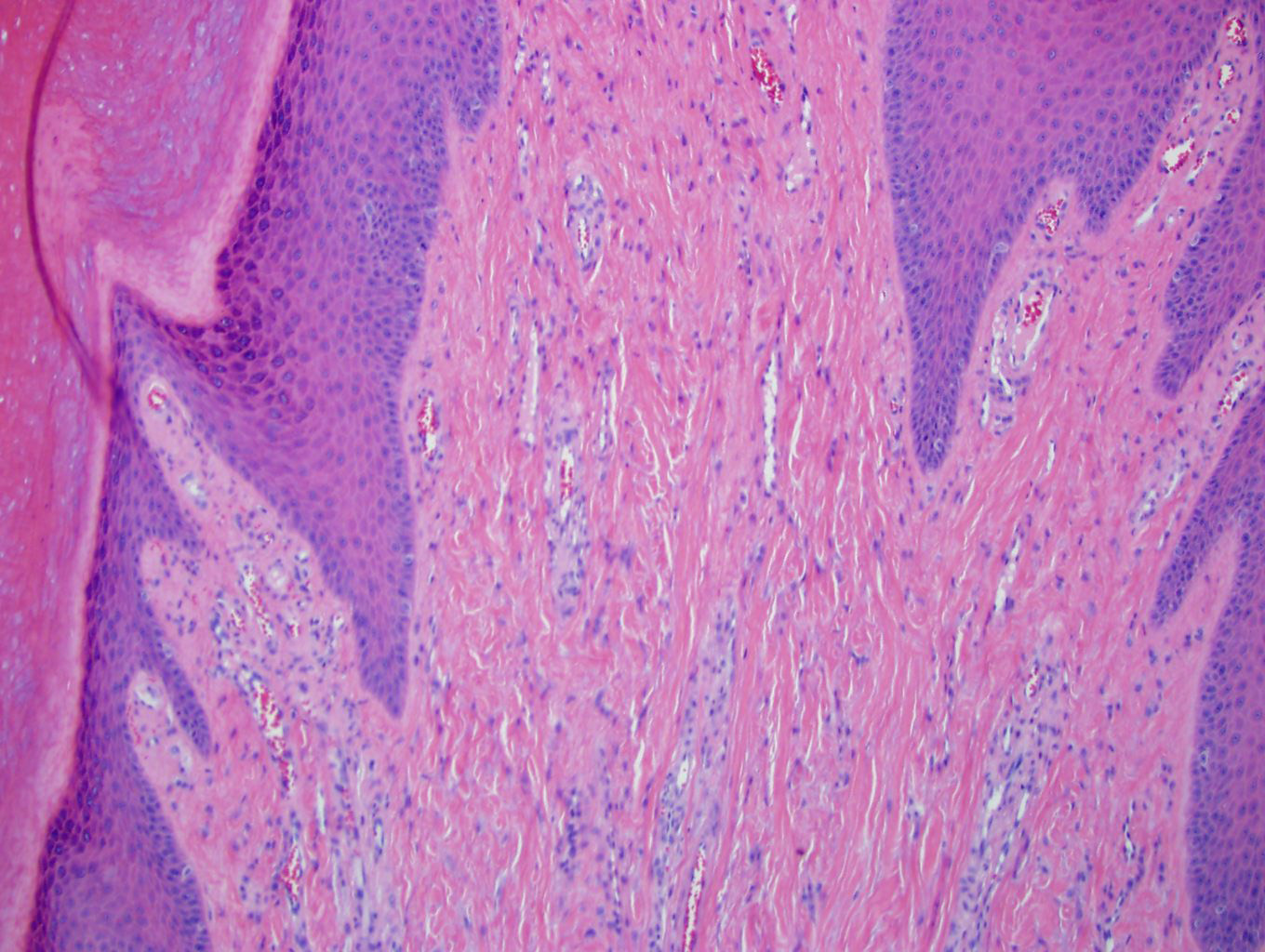 Prominent dense collagen