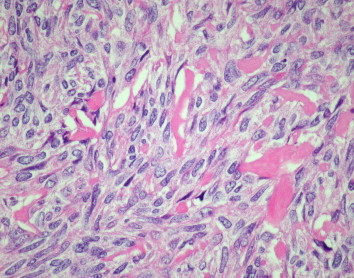 Spindle cell appearance