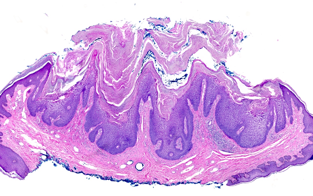 Papillomatous pattern of epidermolytic acanthoma