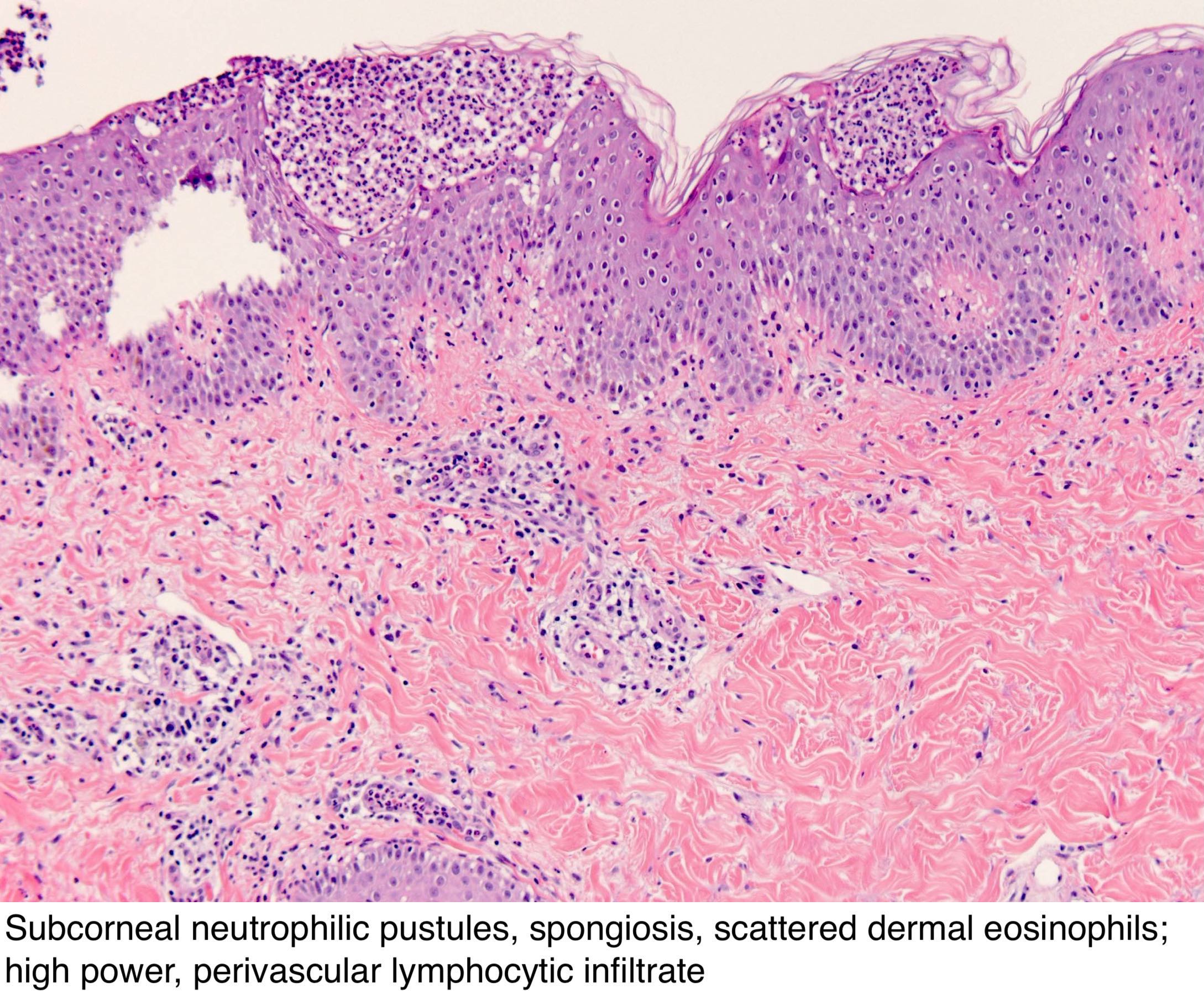 psoriasis vulgaris pathology outlines