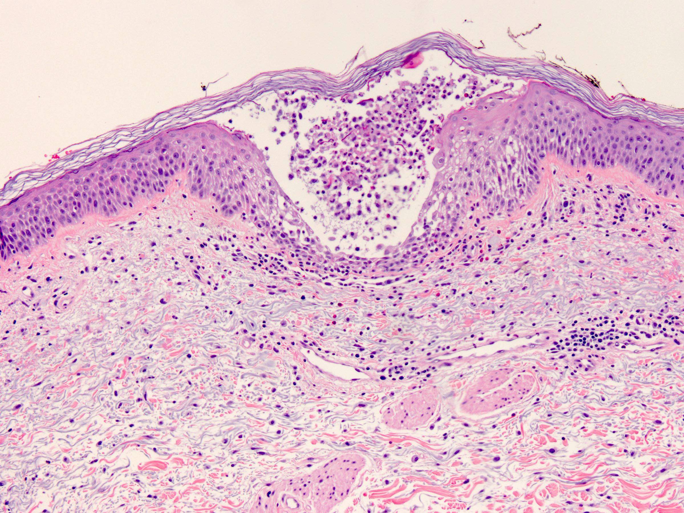 palmoplantar pustulosis pathology