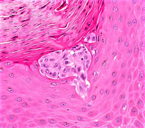 Langherhans cell microabscess