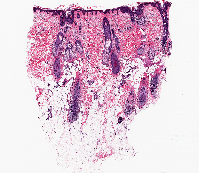 Vertical section of scalp biopsy