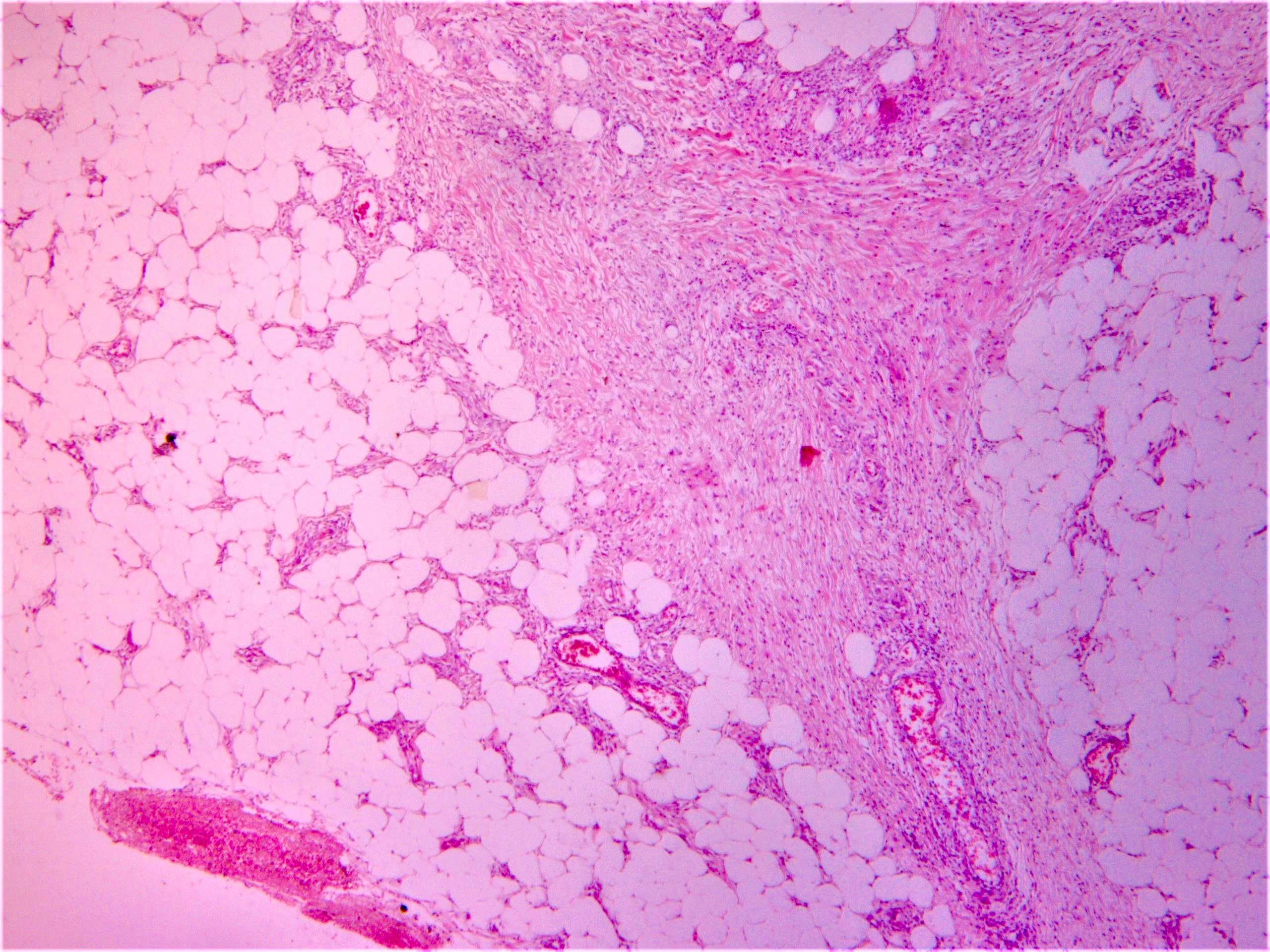Erythema nodosum-like lesion