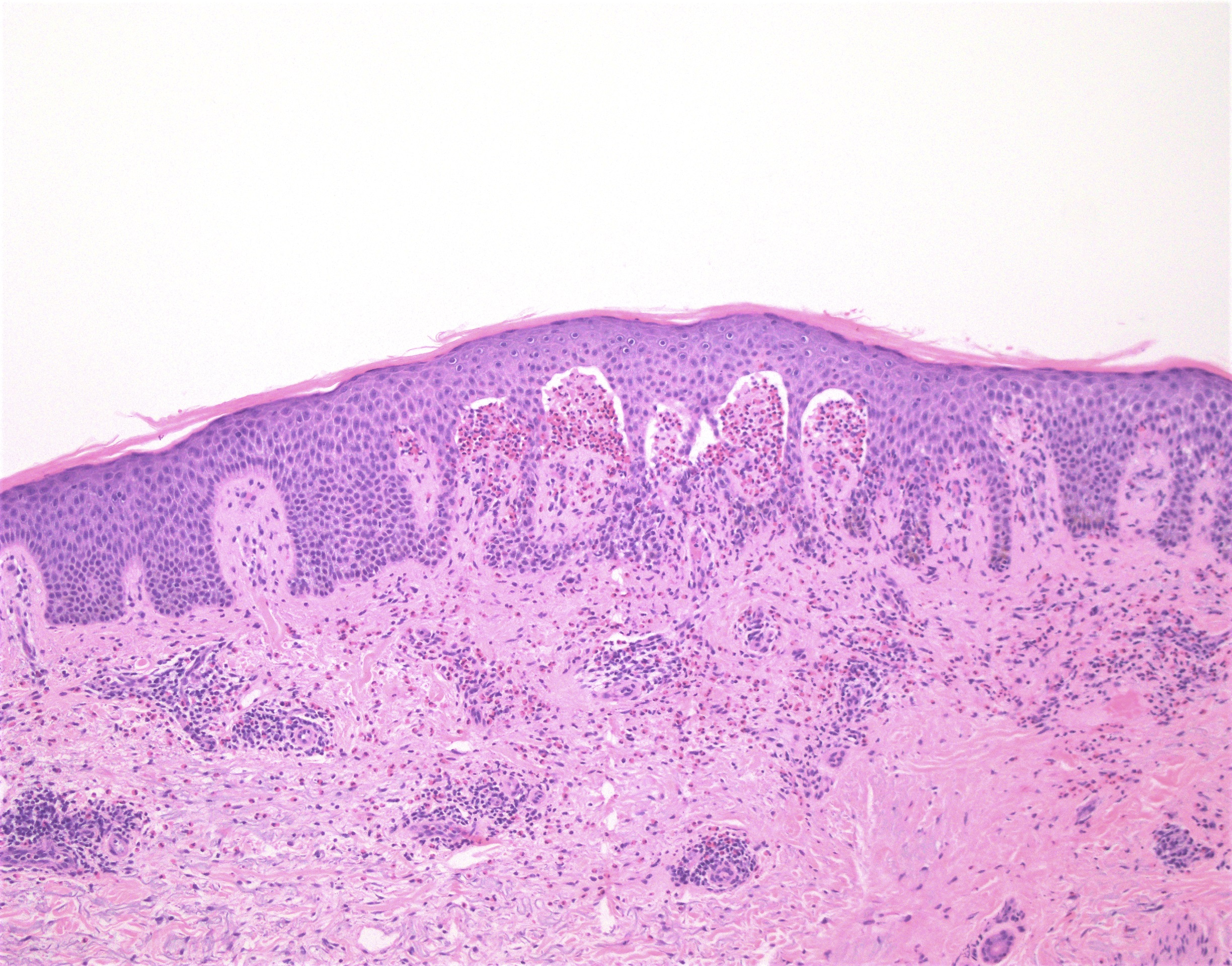 Eosinophil microabscesses in papillary dermis