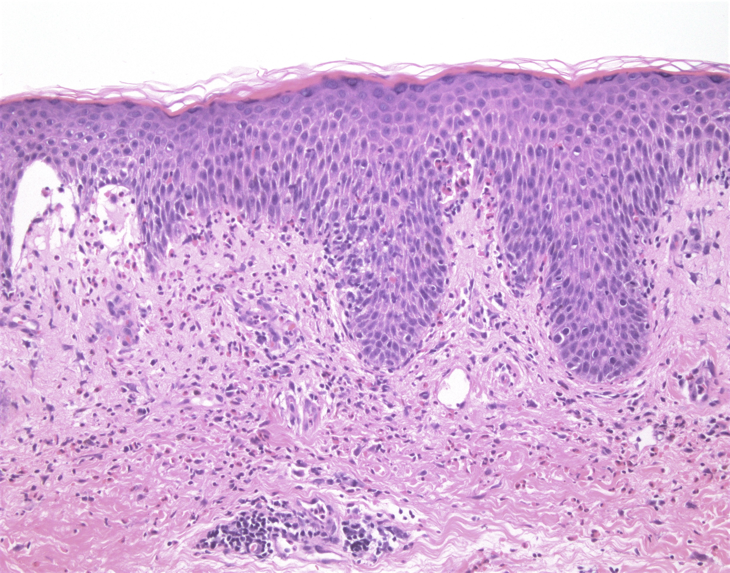 Eosinophilic spongiosis with adjacent subepidermal blister