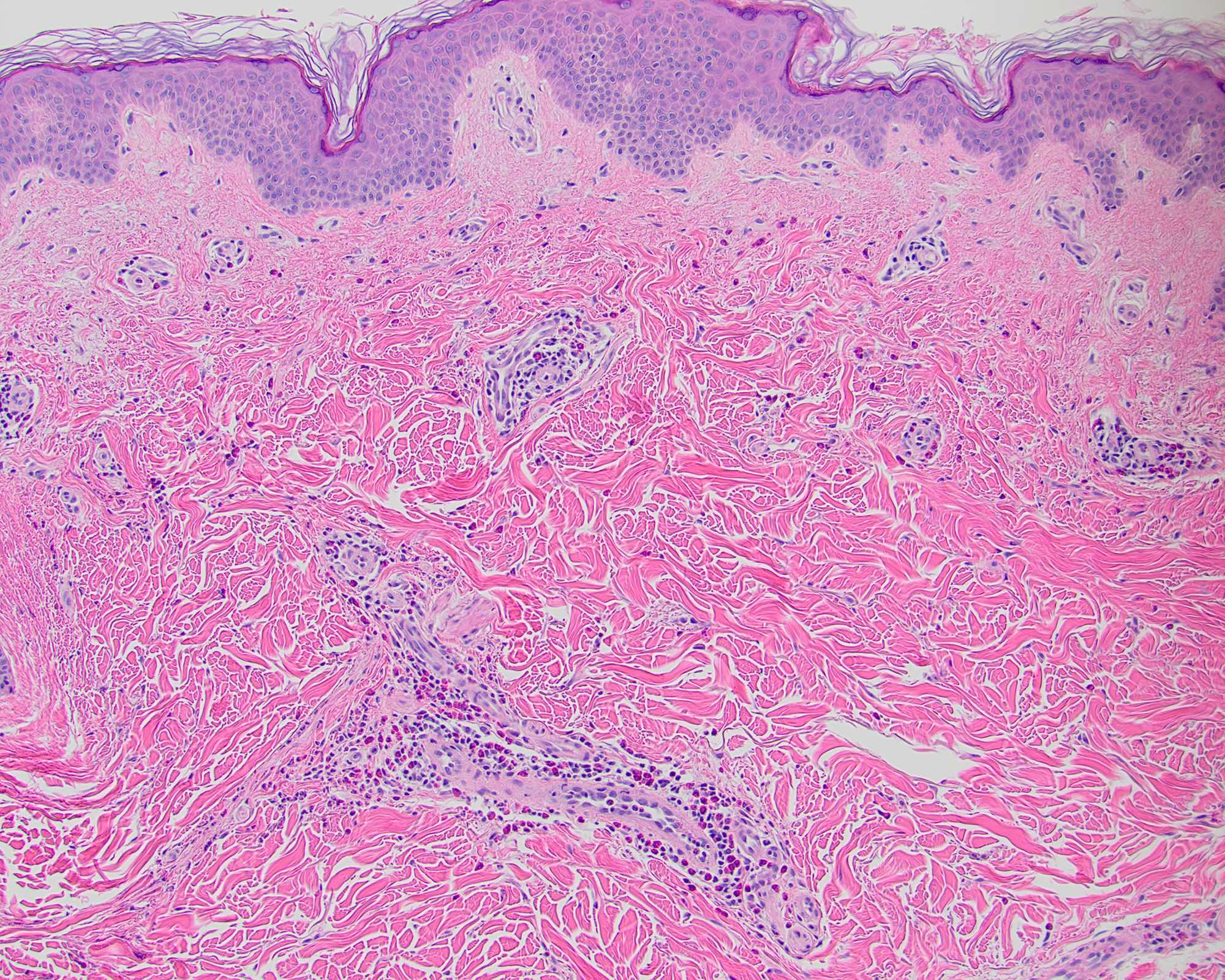 Allergic Contact Dermatitis Histology