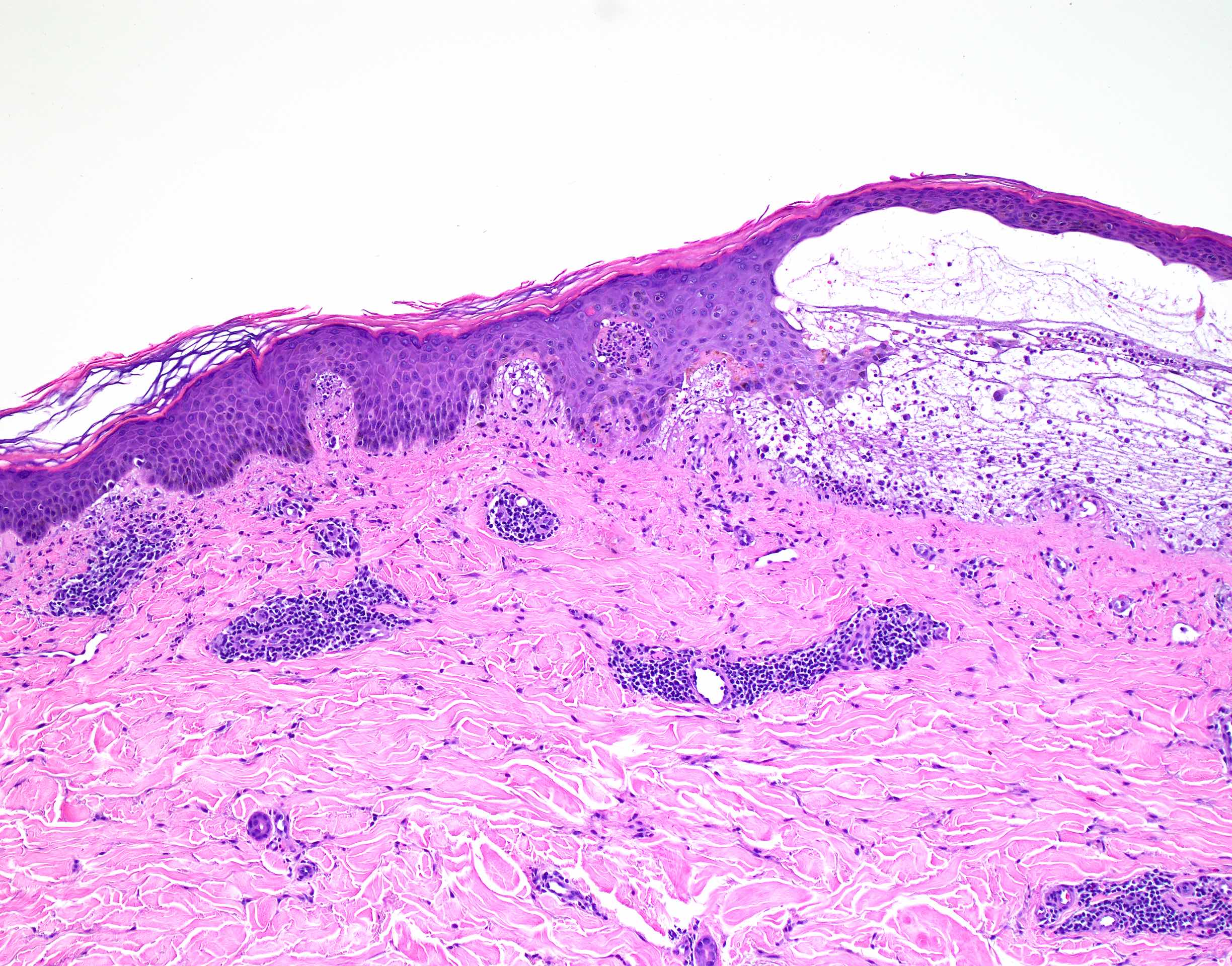 Dermatitis Herpetiformis Histology