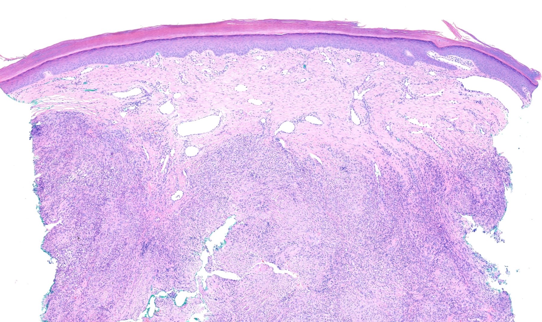 Dilated vessels and prominent fibrosis 