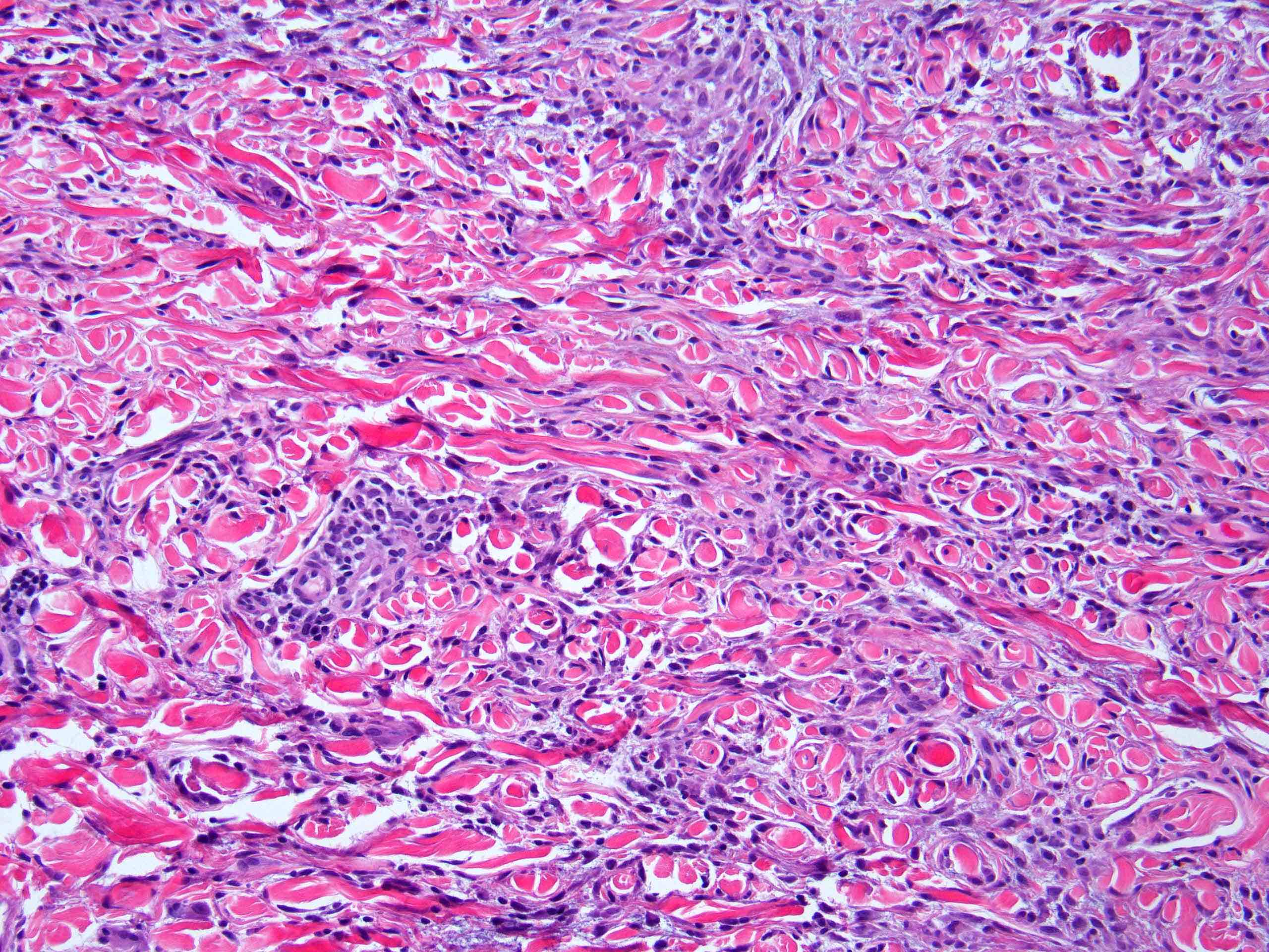 Interstitial histiocytic infiltrate