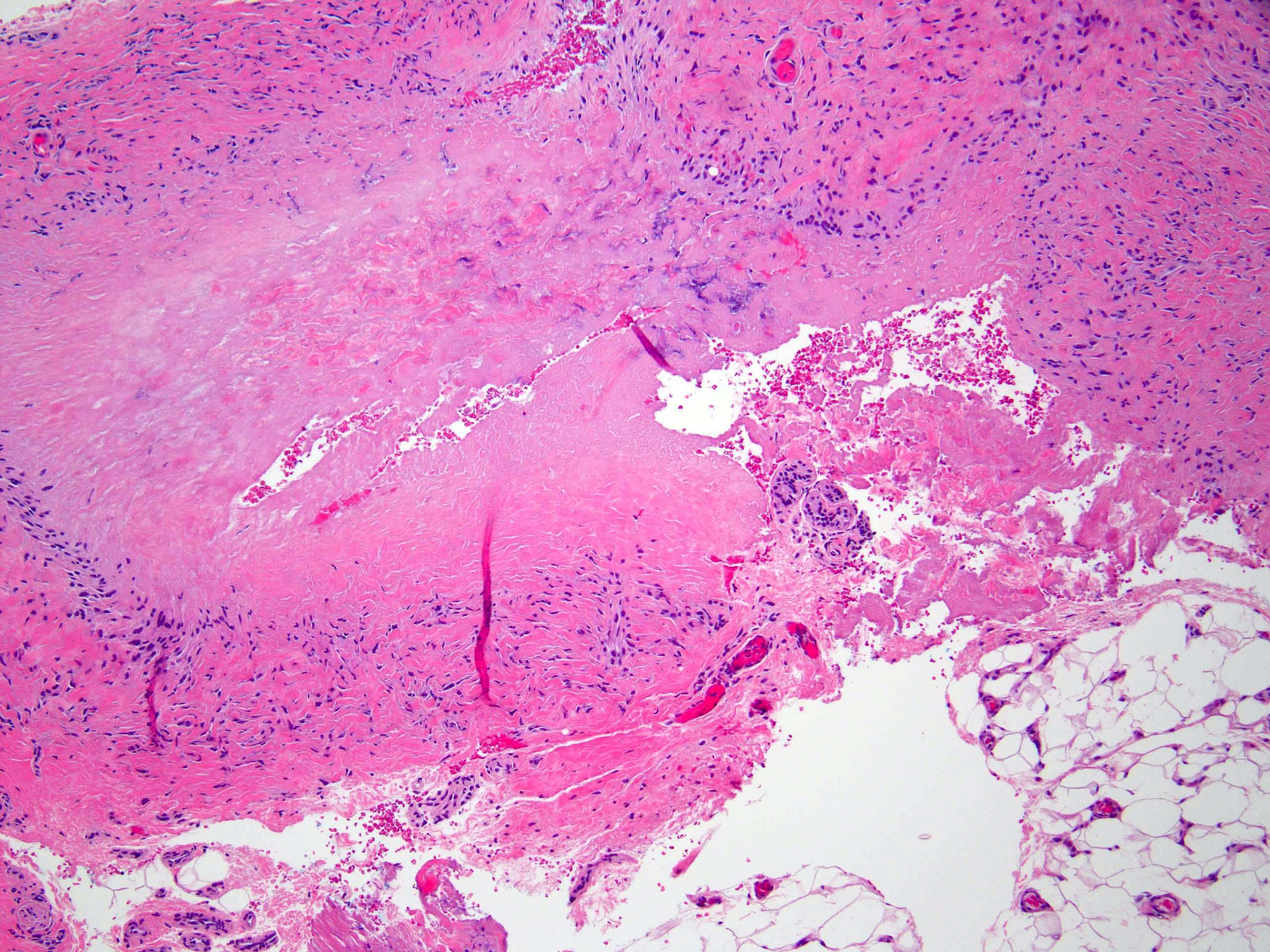 Deep palisaded granuloma with fibrinoid degeneration