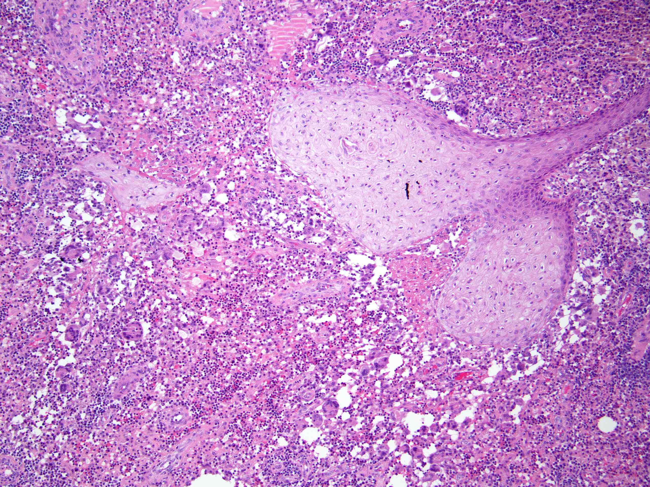 Epithelial remnants with inflammation