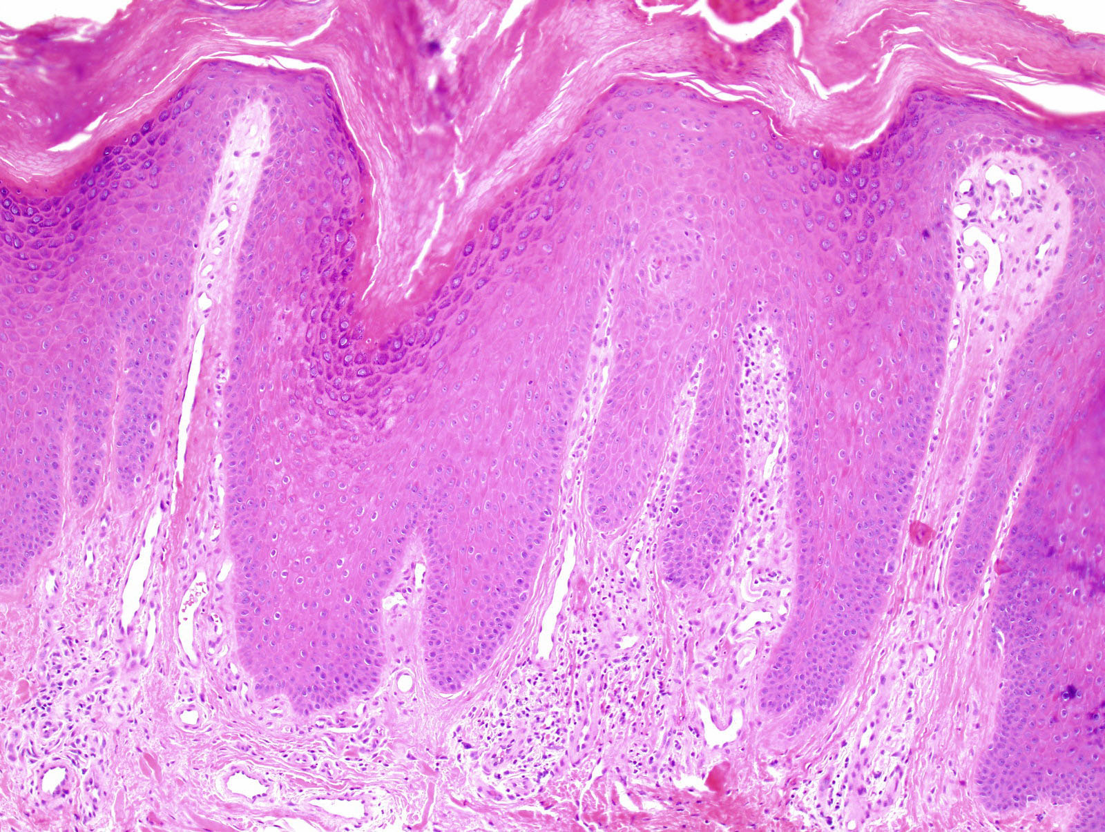 Vertically oriented dermal fibrosis