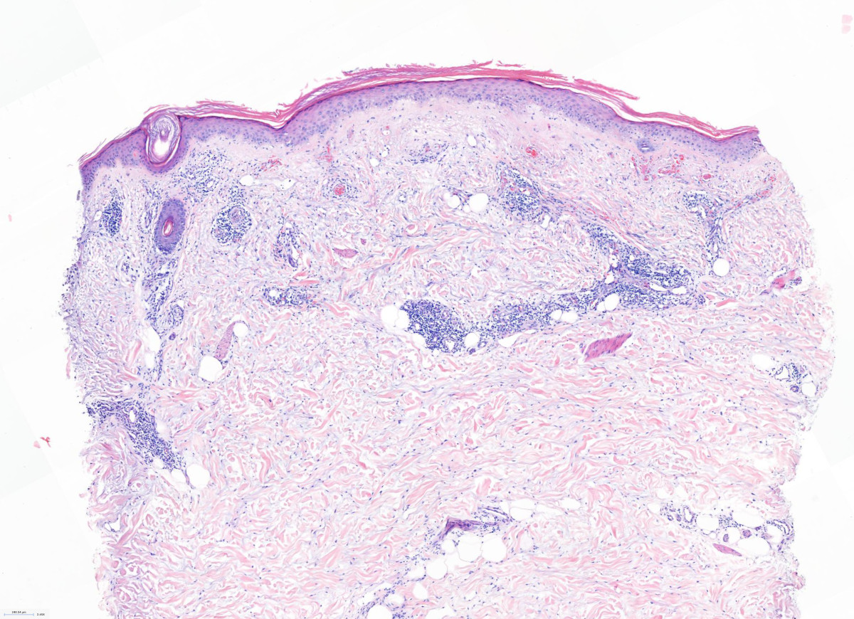 Atrophic papulosis in the context of systemic lupus erythematosus 
