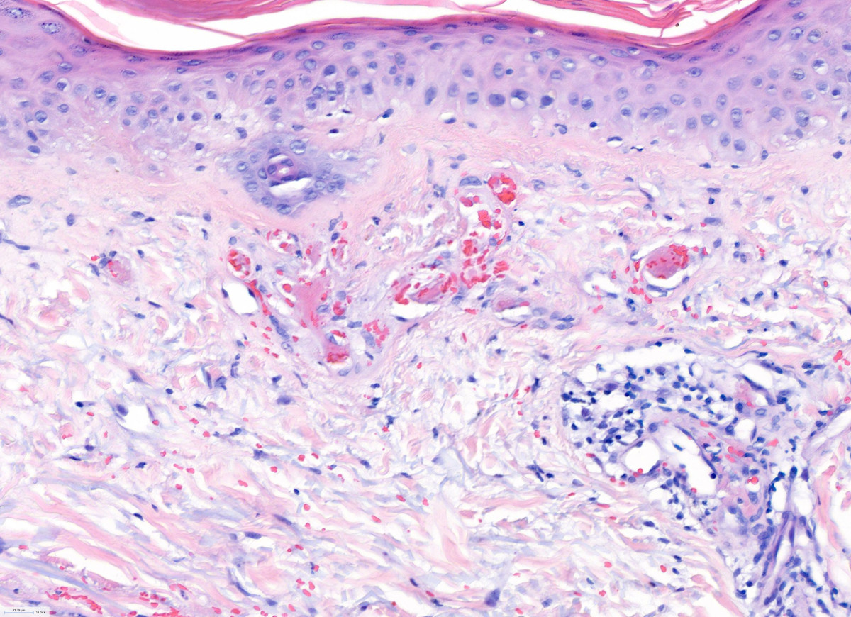 Atrophic papulosis in the context of systemic lupus erythematosus 