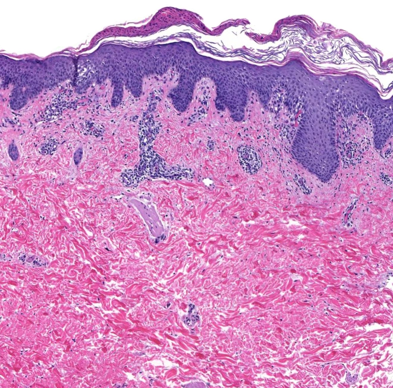 Spongiosis with mounds of parakeratosis