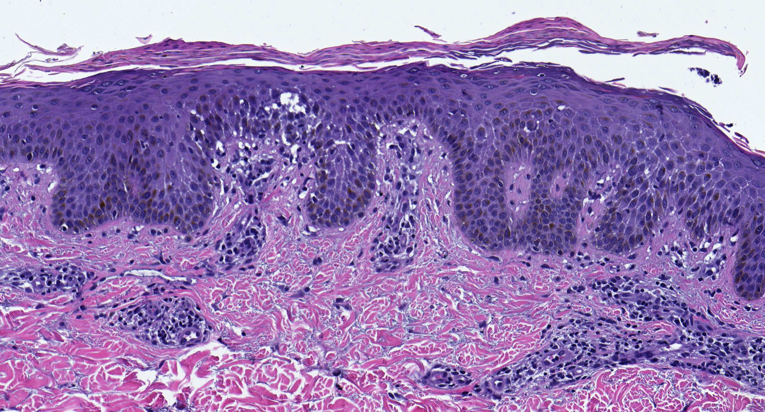 Spongiosis, parakeratosis, superficial lymphocytic infiltrate
