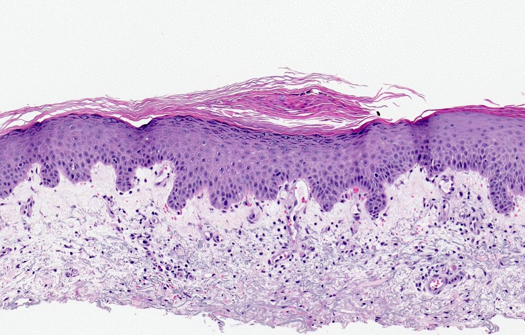 plaque psoriasis histology)