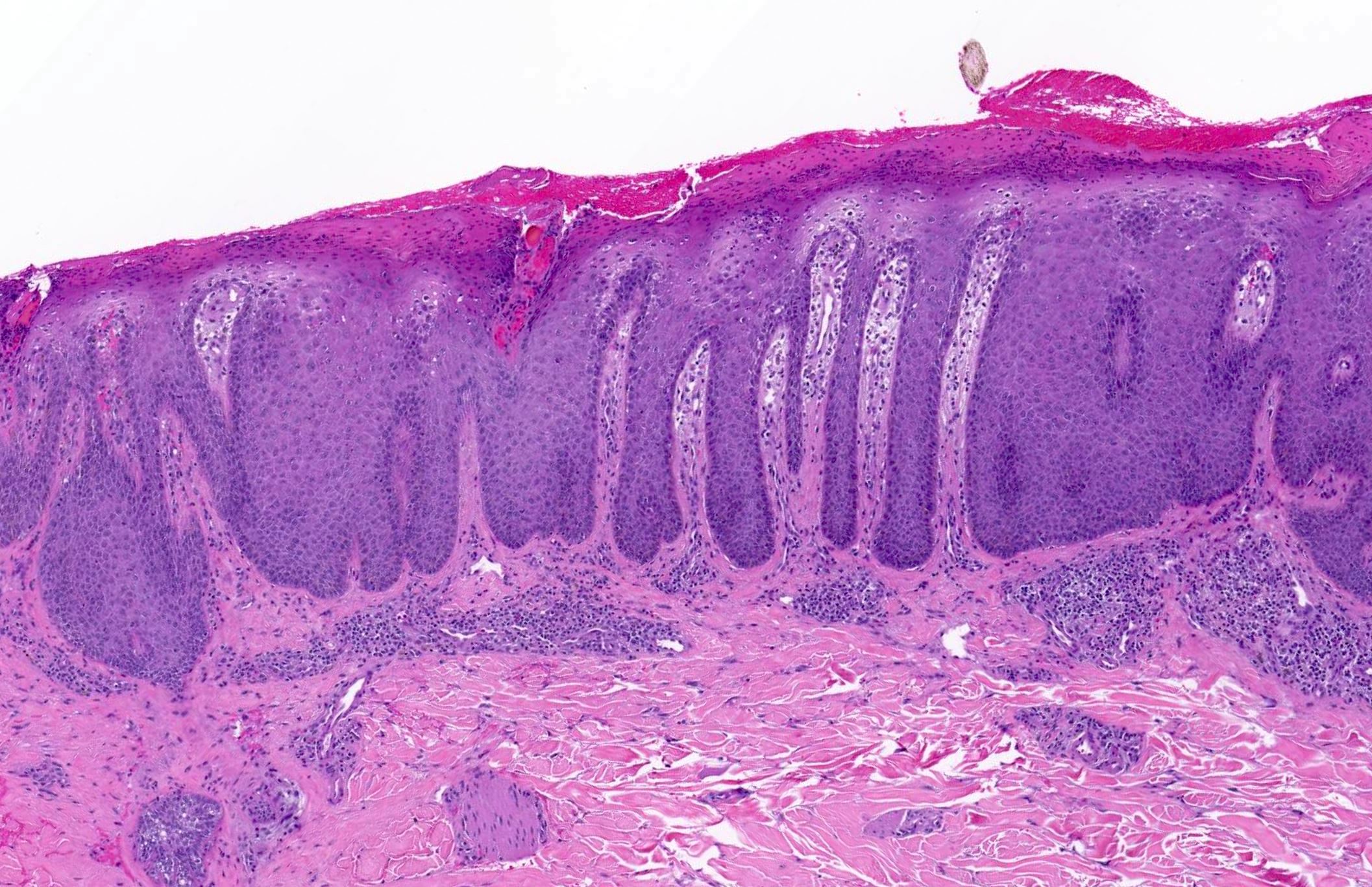 plaque psoriasis histology