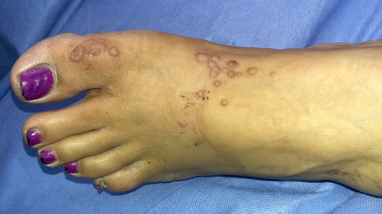 Wart right foot icd 10, Wart right foot icd 10