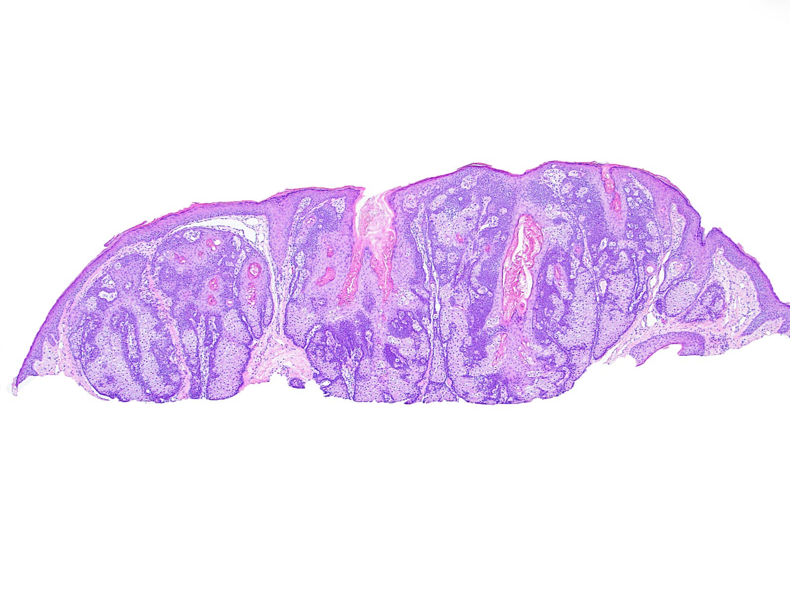 Peripherally basaloid, centrally clear lobules