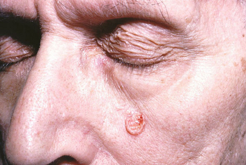 Ulcerated papule on the face