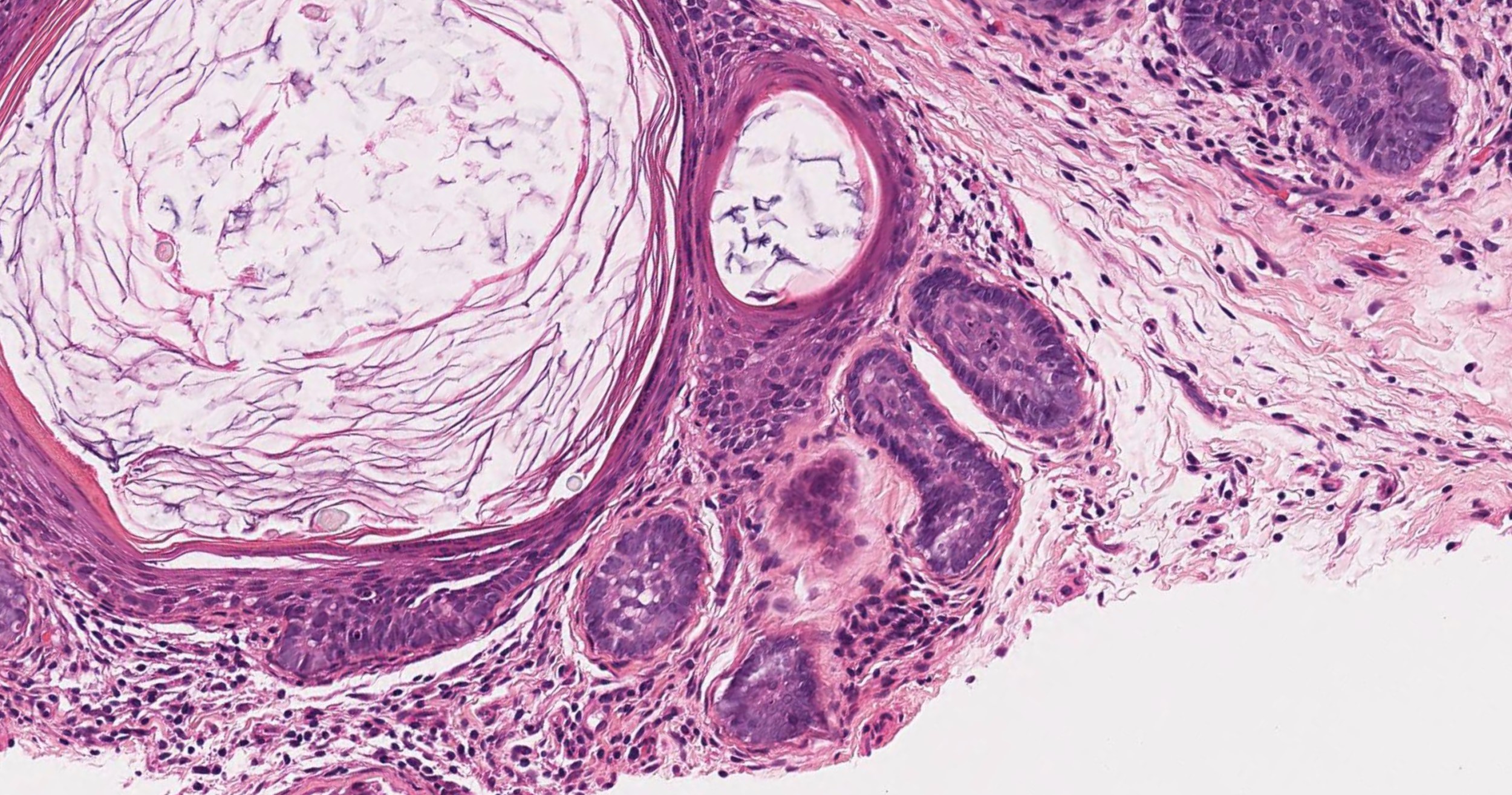 Primary cystic follicle