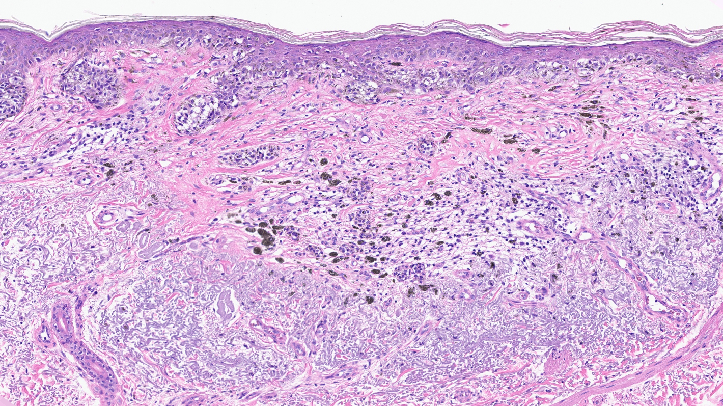Dermal nests with fibrosis