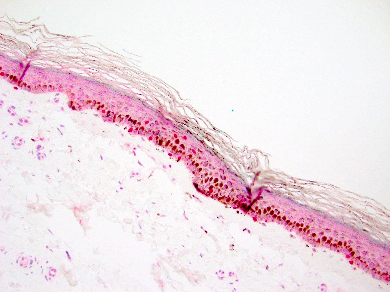 Pathology Outlines - Atypical melanocytic proliferation