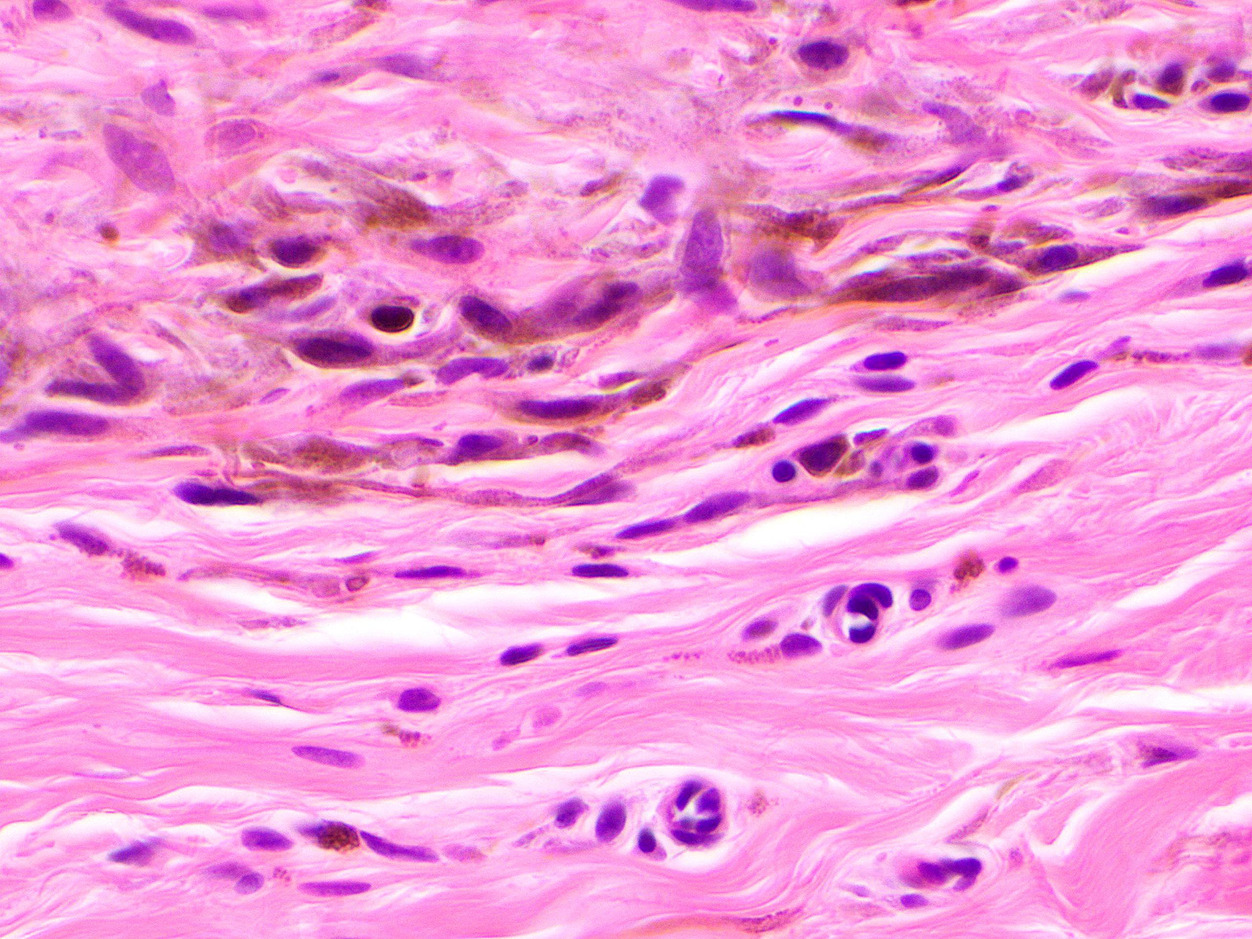 Pigmented dendritic melanocytes