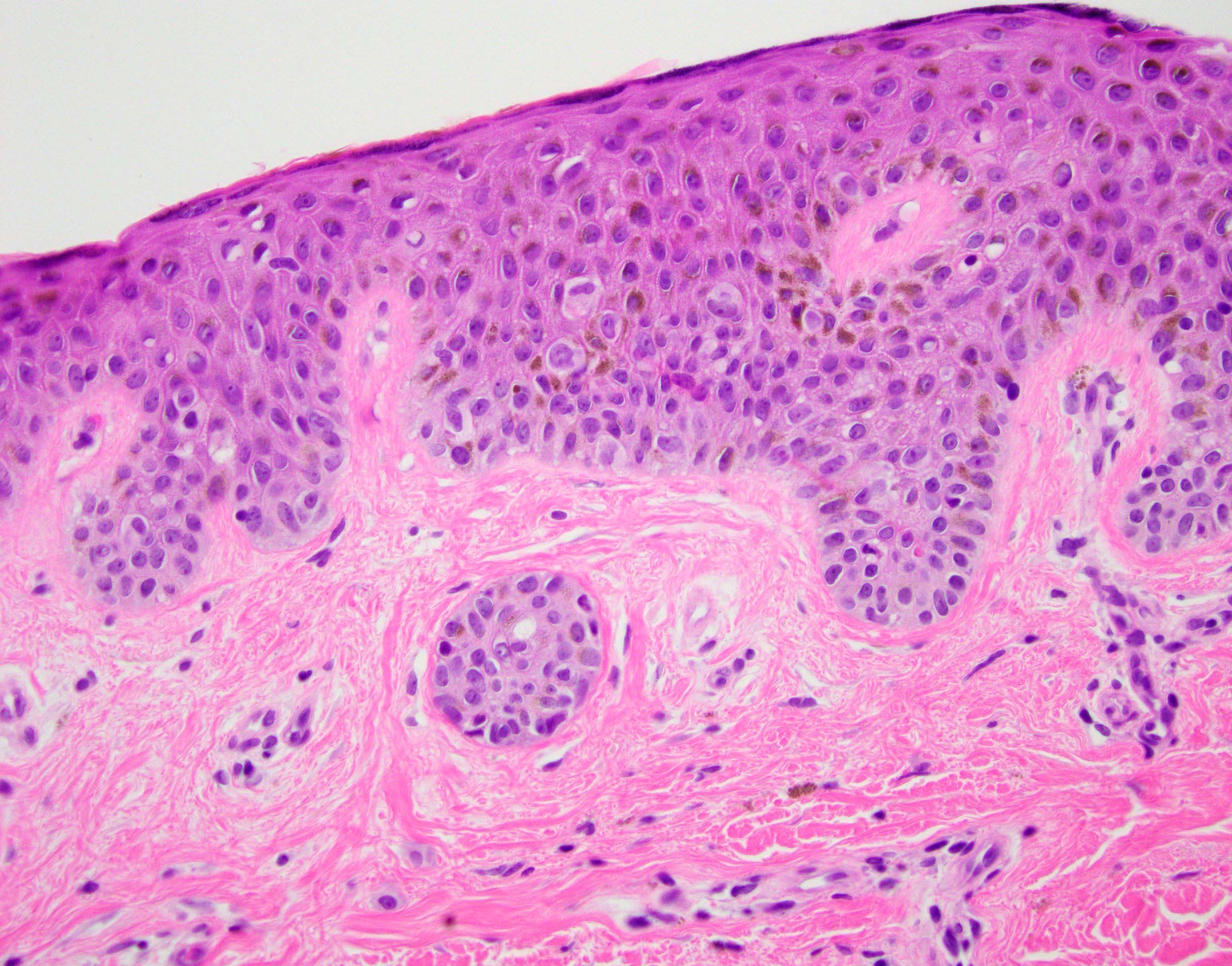 Dysplastic compound nevus with focally severe atypia