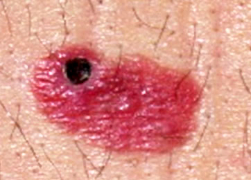 melanoma pathology achromic