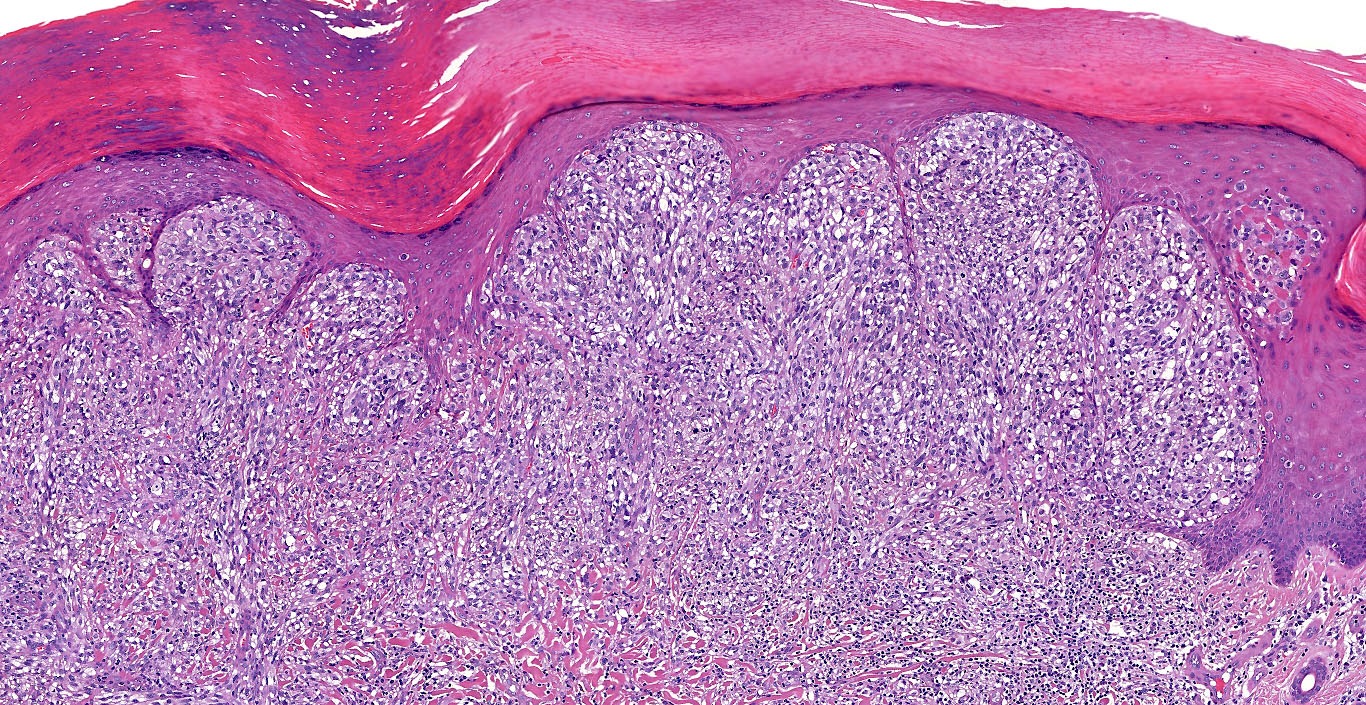 Acral lentiginous melanoma, vertical growth phase