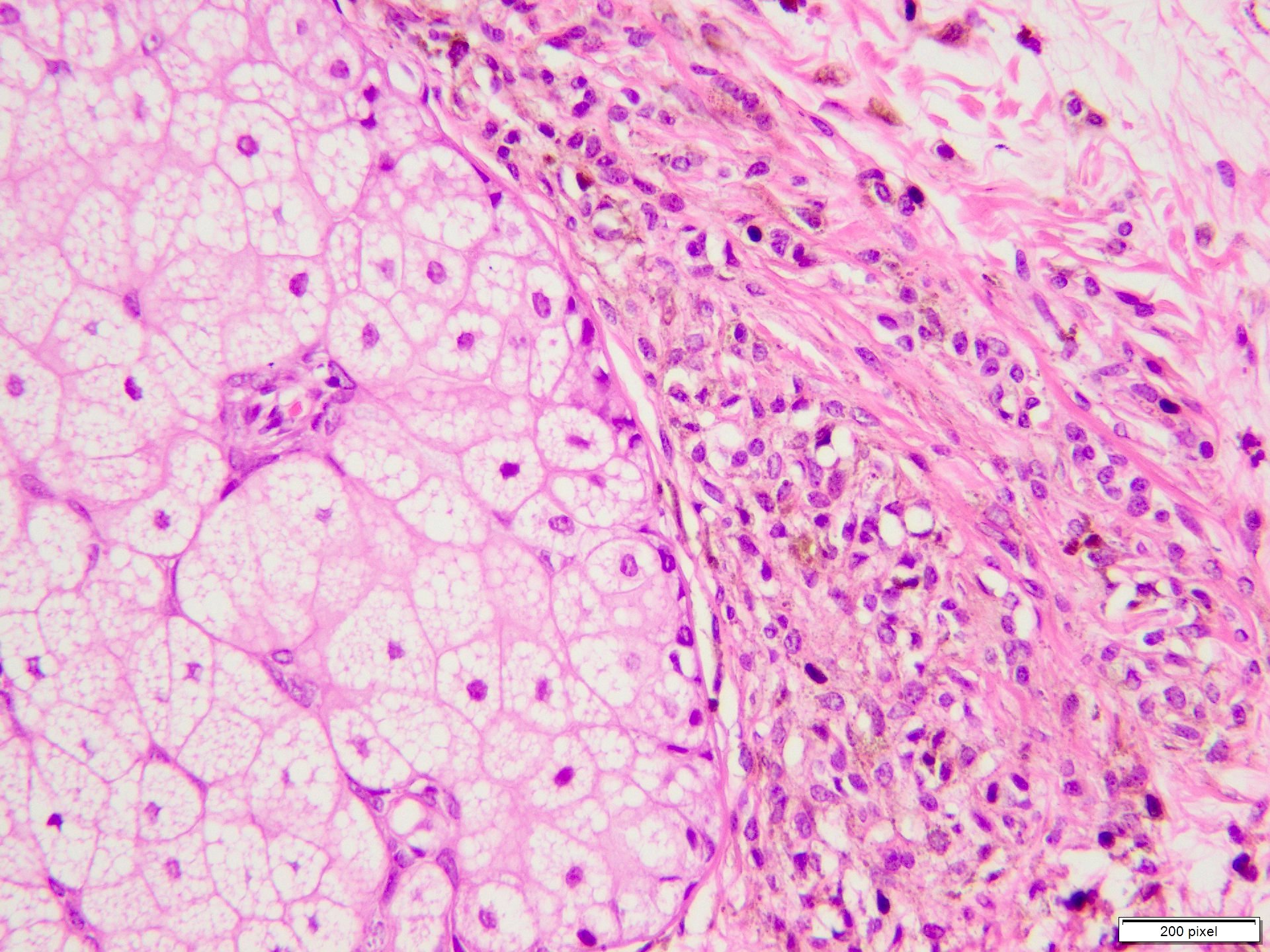 Background nevus cell around sebaceous units